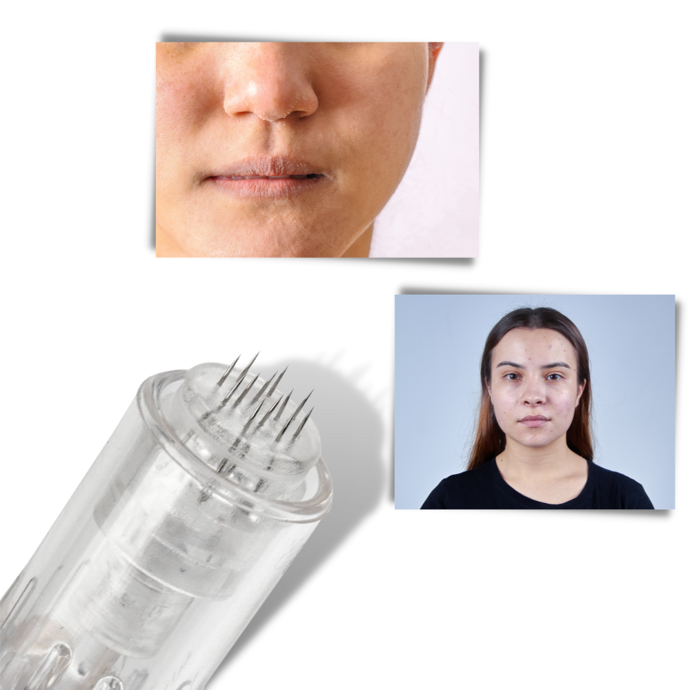 Dermal Microneedling Kalem - Ozerty